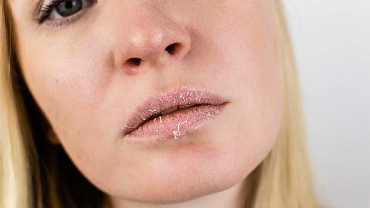 Frauengesicht mit trockenen Lippen